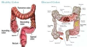 What Happens After Colon Hydrotherapy? 2 colon cleanse machine 2
